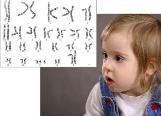 Scientists at the University of Massachusetts Medical School have "switched off" the chromosome that causes the symptoms of Down's syndrome in human cells in the lab