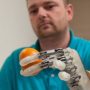 Bionic hand allows amputee to feel lifelike sensation
