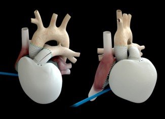 The Carmat heart is designed to work for five years