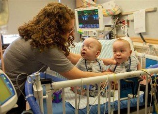 Conjoined twins Owen and Emmett Ezell were separated at Medical City Children's Hospital in Dallas in August 2013
