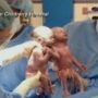 Jillian and Jenna Thistlethwaite: Ohio twins born holding hands