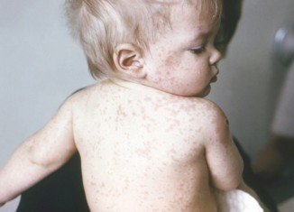 The CDC reported 288 cases of measles in the first five months of 2014, the largest number for 20 years