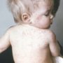 Measles outbreak 2014: US cases reach 20-year high