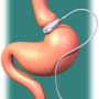 The Facts You Need about Lap Band Surgery