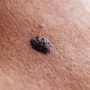 Number of Moles on Right Arm Predicts Skin Cancer Risk
