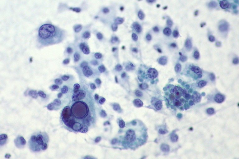 Melanoma Study: Ipilimumab and Nivolumab Eliminate 20% of Tumors