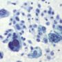Melanoma Study: Ipilimumab and Nivolumab Eliminate 20% of Tumors