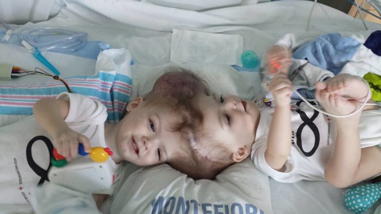 Jadon and Anias McDonald: Conjoined Twins Separated in New York