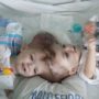 Jadon and Anias McDonald: Conjoined Twins Separated in New York