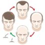 All you need to know about hair transplants