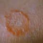 Ringworm: How it Spreads & How to Deal With It