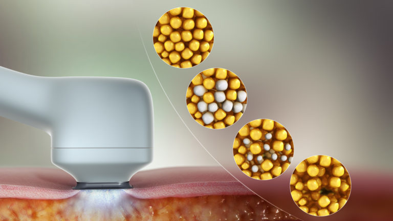 The Coolsculpting Essentials