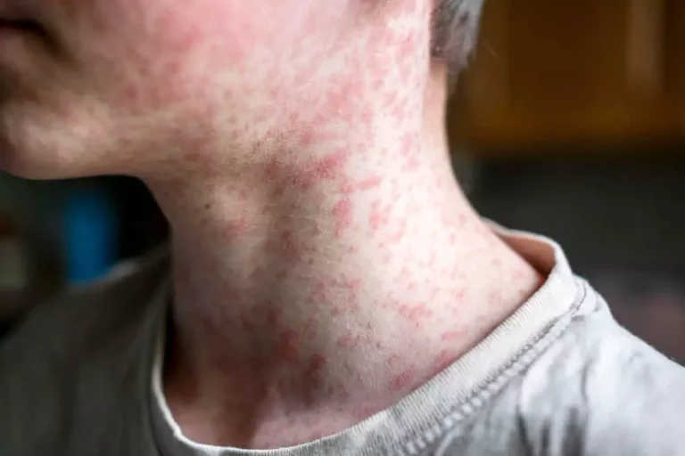 Canada Forfeits Measles-Free Status as Low Vaccination Rates Threaten All of North America