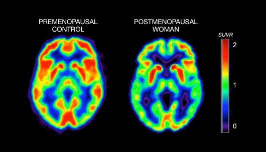 New Research Links Menopause to ‘Alzheimer’s-Like’ Brain Shrinkage